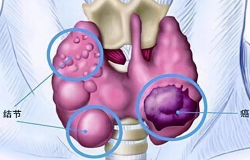 甲状腺肿瘤的症状表现，甲状腺肿块/喉咙不适/功能异常