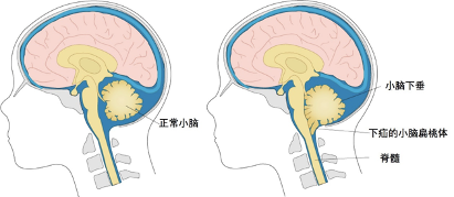 颅颈交界区畸形后果