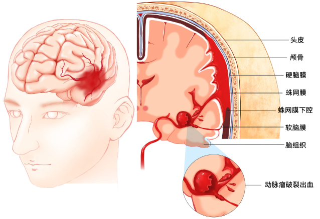 颅脑创伤目前临床应用最多最可靠的检查是头部CT扫描