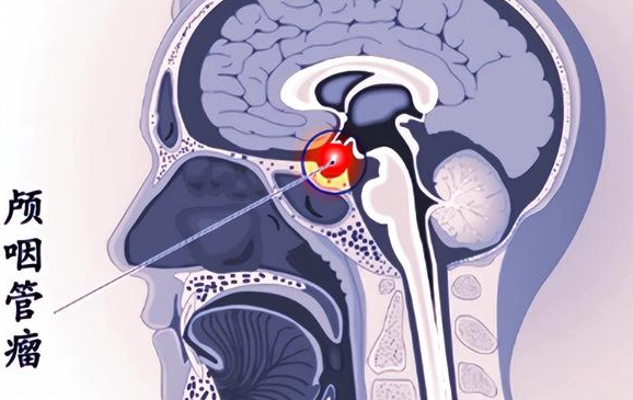 颅咽管瘤手术成功率，手术过程成功率高达80%至90%