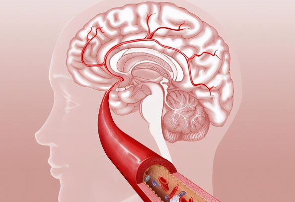 脑出血是什么原因造成的？高血压/动脉瘤和动脉硬化等