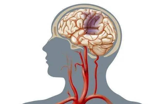 脑动脉瘤介入手术后的寿命，10年生存率可达到90%以上