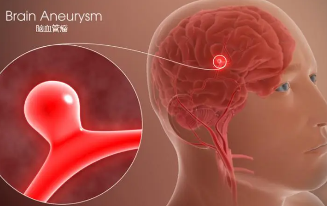 脑动脉瘤是什么病？血管壁异常扩张的疾病