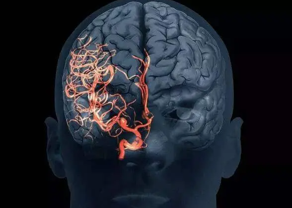 脑动脉瘤是什么原因引起的，遗传/高血压和动脉硬化等