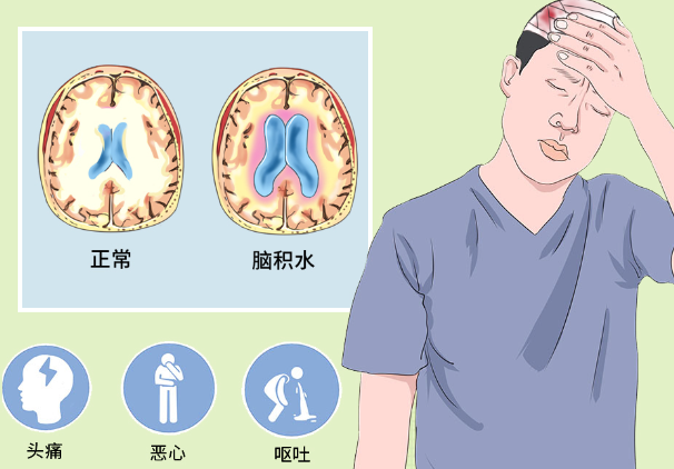 脑积水的人能活多久，及时诊断治疗延长患者的生存时间