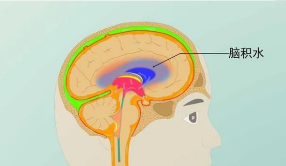 脑积水能治好吗？合理的治疗可有效缓解脑积水的症状
