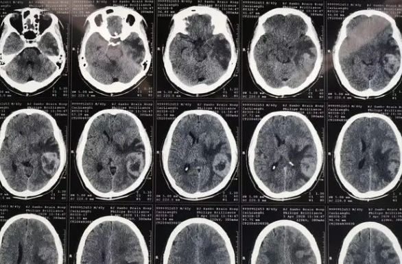 脑膜转移瘤的影像学表现