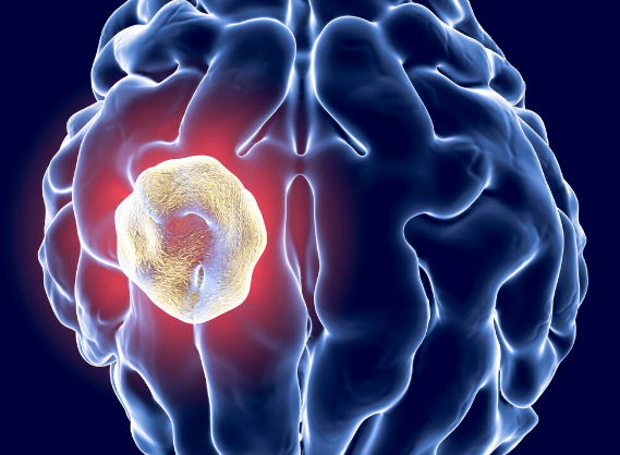 脑囊肿是什么病严重吗，脑内或脑膜下形成的腔隙病变