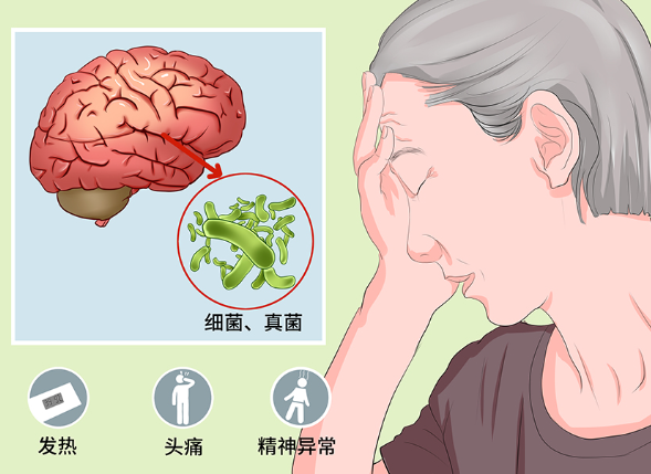 脑脓肿破裂感染颅内能治好吗？及时发现治疗能提高效率