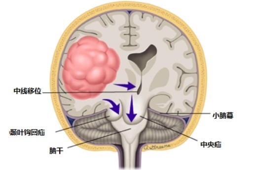 什么是脑疝？一种严重的神经系统疾病