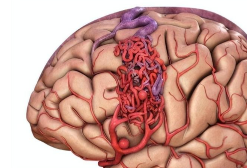 脑血管畸形会遗传下一代吗，会在发病中起到一定作用