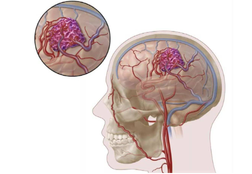 脑血管畸形能活多少岁，不是一个绝对限制寿命的疾病