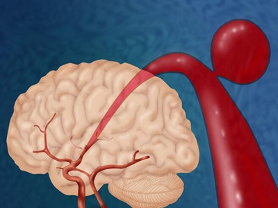 脑血管痉挛吃什么药效果最好，钙通道阻滞剂/镇痉剂等