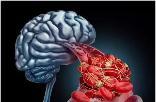脑血管痉挛是什么原因引起的，高血压/糖尿病和吸烟等