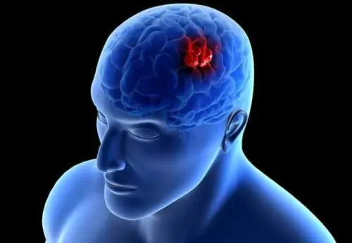 脑肿瘤晚期有什么症状能活多久，寿命受多个因素影响