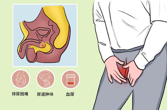 尿道癌是什么，恶性肿瘤发生在尿道内的一种癌症