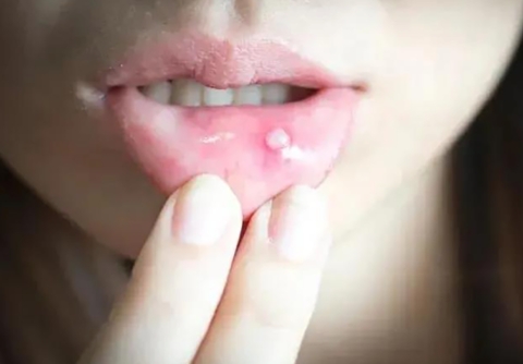 口腔溃疡缺少哪种维生素，维生素B12