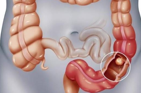 溃肠性结肠炎能治好吗，溃肠性结肠炎的治疗方法