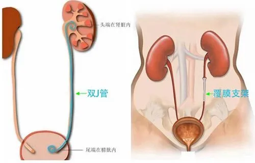尿道狭窄的治疗方法