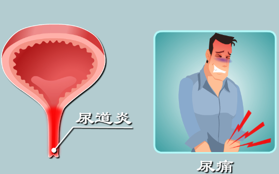 尿道炎的症状有哪些，尿频尿急/尿道口红肿和出血等