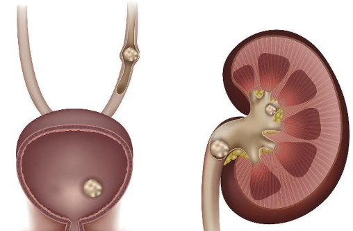 尿石症是什么？尿路疾病，尿液中形成固体结晶体或结石