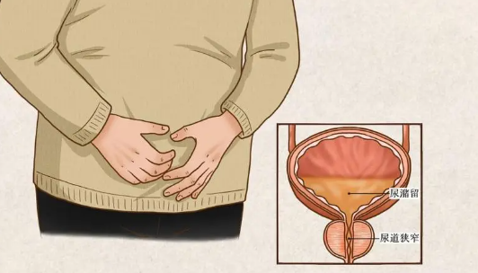 尿潴留是什么症状，尿频/尿急/尿失禁和尿液淋漓不尽等