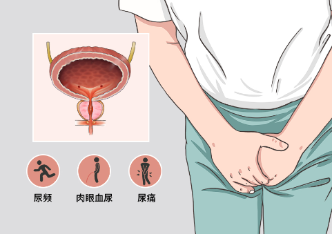 尿潴留是怎么回事，由尿道梗阻或膀胱肌肉问题引起的