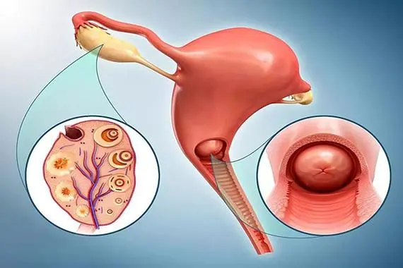 卵巢小细胞癌晚期痛苦，盆腔肿块/乏力/恶心