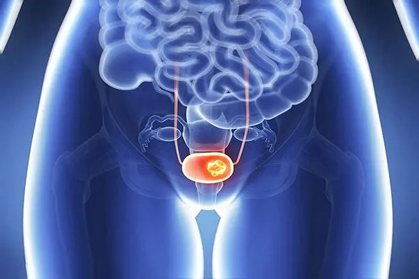 卵巢小细胞癌痊愈案例分享，全面对抗卵巢小细胞癌的重要性