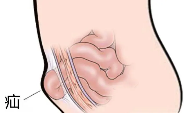疝气睾丸肿大怎么消肿，手动复位/手术和观察并保持安静