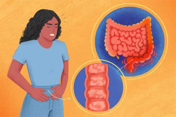 慢性结肠炎直肠炎怎么根治，药物治疗/饮食调整和手术治疗