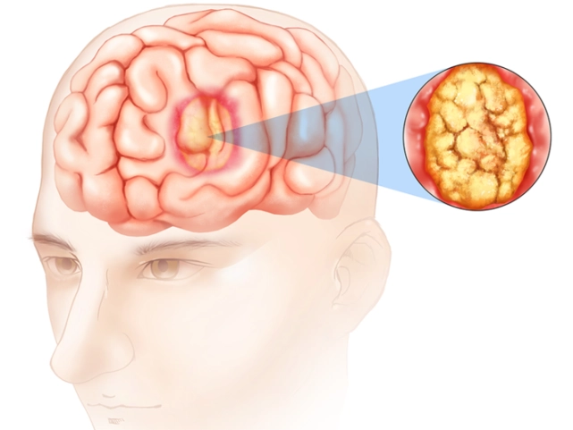 神经胶质瘤复发率，受多种因素影响的复杂问题
