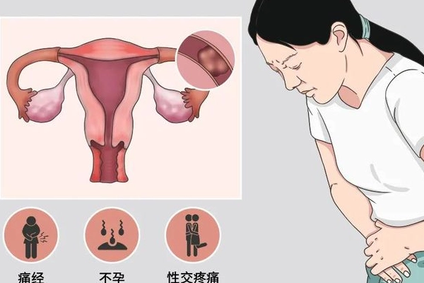 排卵障碍的症状是什么，月经不调/无排卵/腹痛