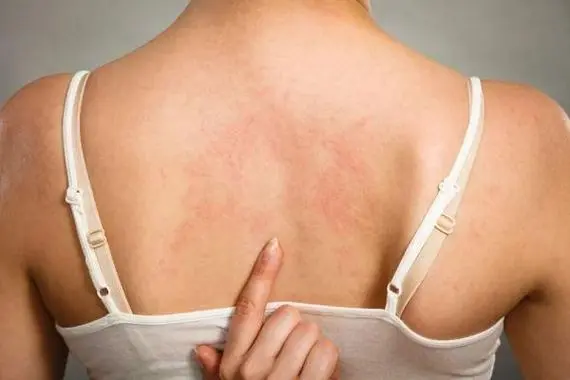 皮肤瘙痒警惕9种疾病，湿疹/牛皮癣/荨麻疹