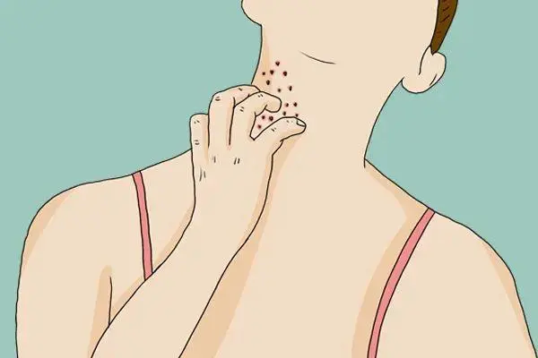 皮肤瘙痒症如何治疗用什么药，抗过敏药物和局部激素药物