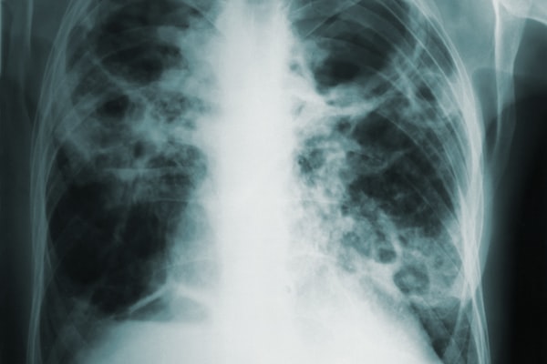 pulmonary edema