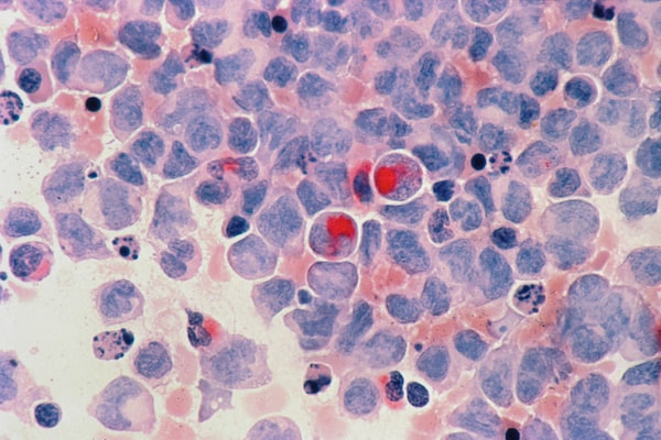 Leukemia